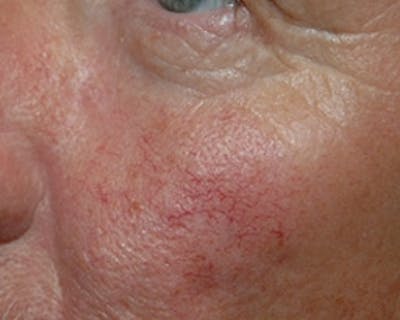 Nasal And Facial Vessels Before & After Gallery - Patient 199732 - Image 1