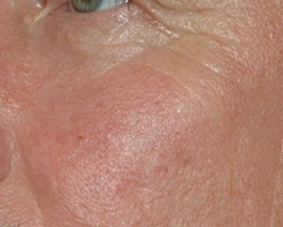 Nasal And Facial Vessels Before & After Gallery - Patient 199732 - Image 2