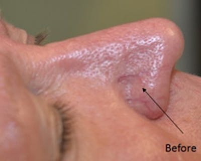 Nasal And Facial Vessels Before & After Gallery - Patient 372614 - Image 1
