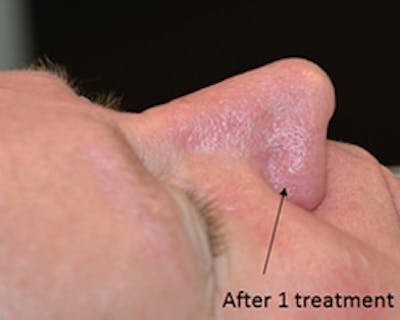 Nasal And Facial Vessels Before & After Gallery - Patient 372614 - Image 2