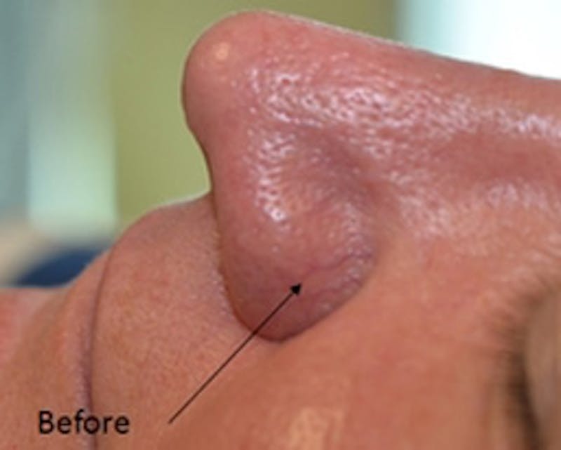 Nasal And Facial Vessels Before & After Gallery - Patient 372614 - Image 3