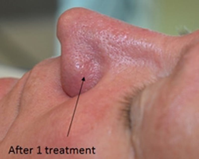 Nasal And Facial Vessels Before & After Gallery - Patient 372614 - Image 4