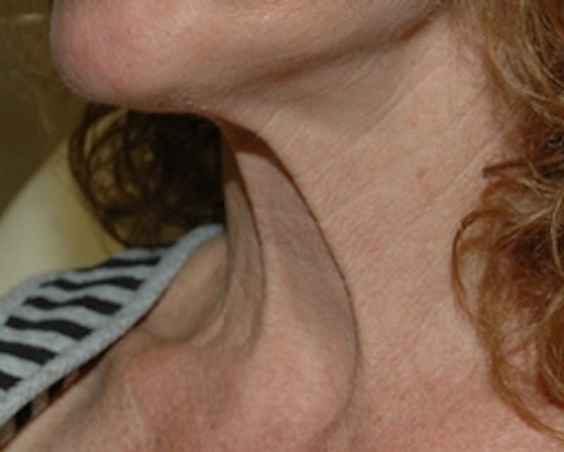 BOTOX Before & After Gallery - Patient 179915 - Image 1