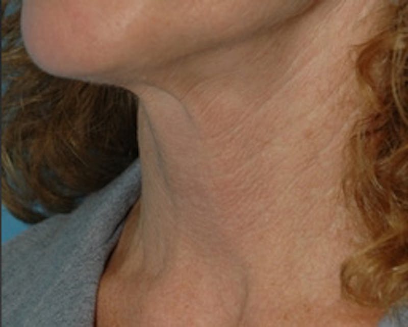 BOTOX Before & After Gallery - Patient 179915 - Image 2