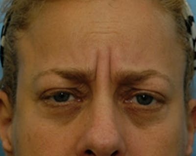 BOTOX Before & After Gallery - Patient 127591 - Image 1