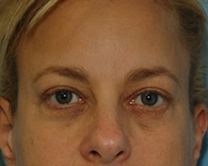 BOTOX Before & After Gallery - Patient 127591 - Image 2
