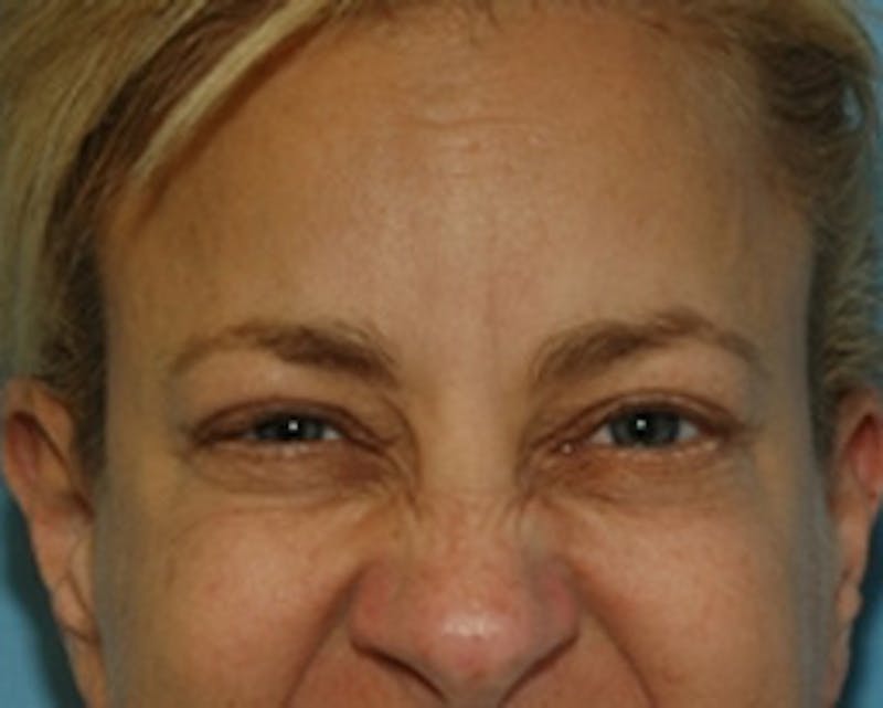 BOTOX Before & After Gallery - Patient 127591 - Image 3