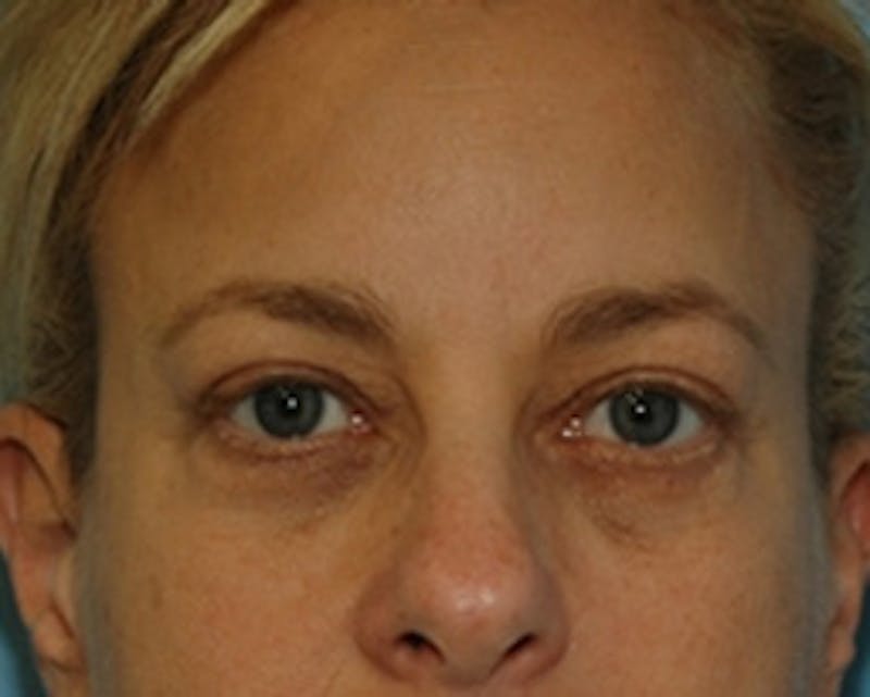 BOTOX Before & After Gallery - Patient 127591 - Image 4