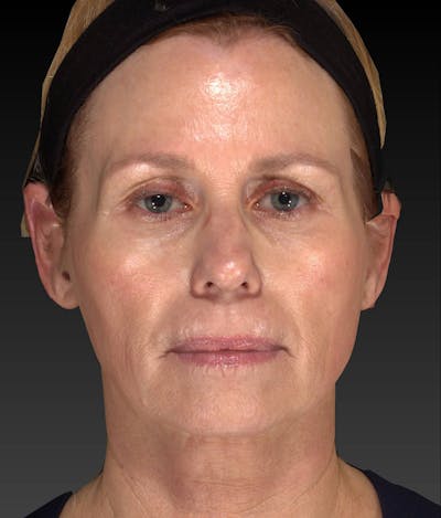Temple Filling Before & After Gallery - Patient 205693 - Image 1