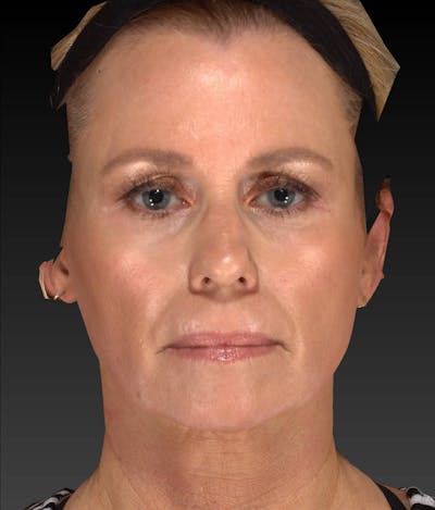 Temple Filling Before & After Gallery - Patient 205693 - Image 2