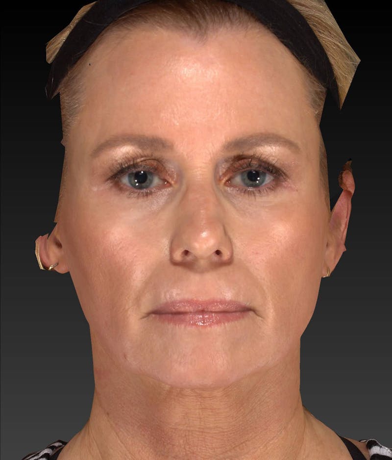 Temple Filling Before & After Gallery - Patient 205693 - Image 2