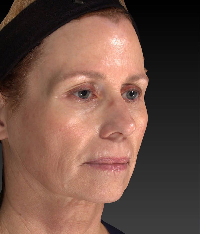 Temple Filling Before & After Gallery - Patient 205693 - Image 3