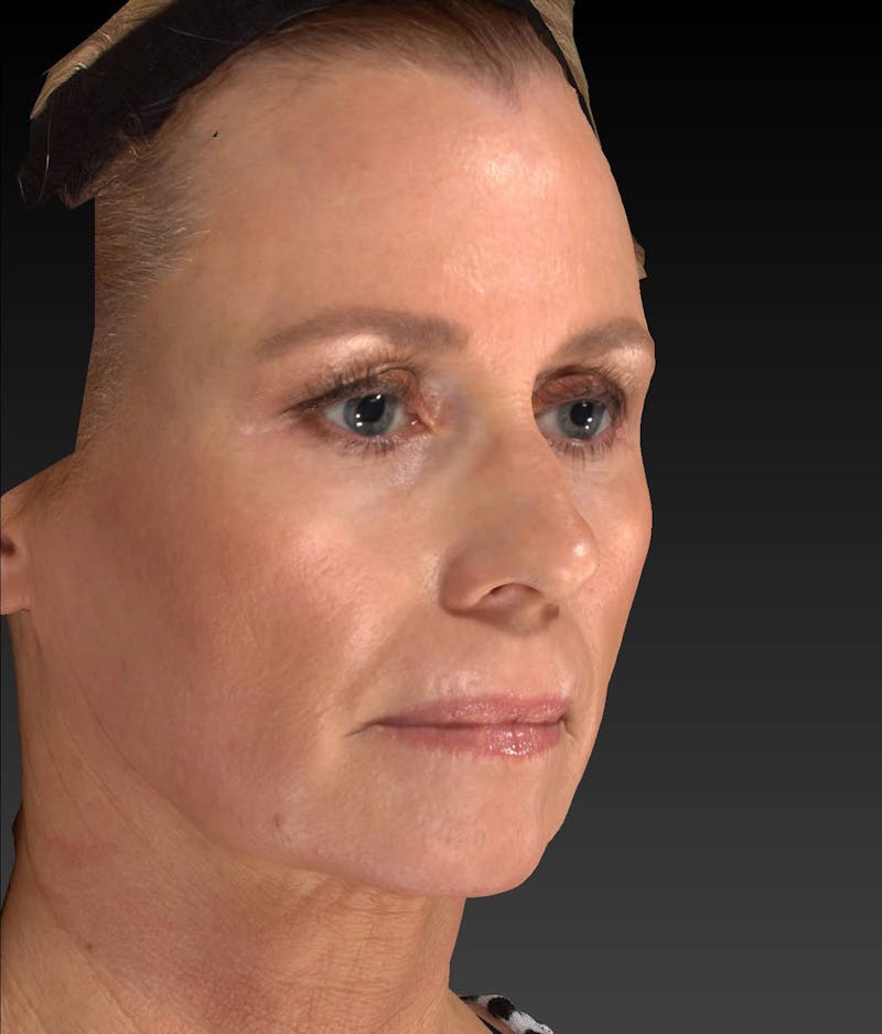 Temple Filling Before & After Gallery - Patient 205693 - Image 4