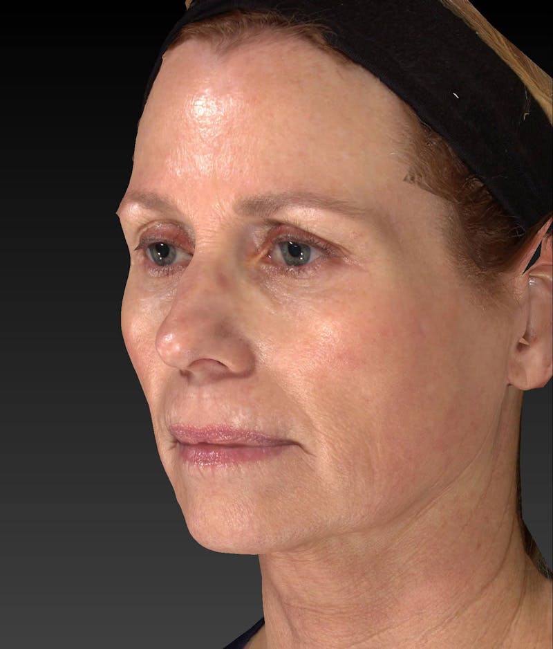 Temple Filling Before & After Gallery - Patient 205693 - Image 5