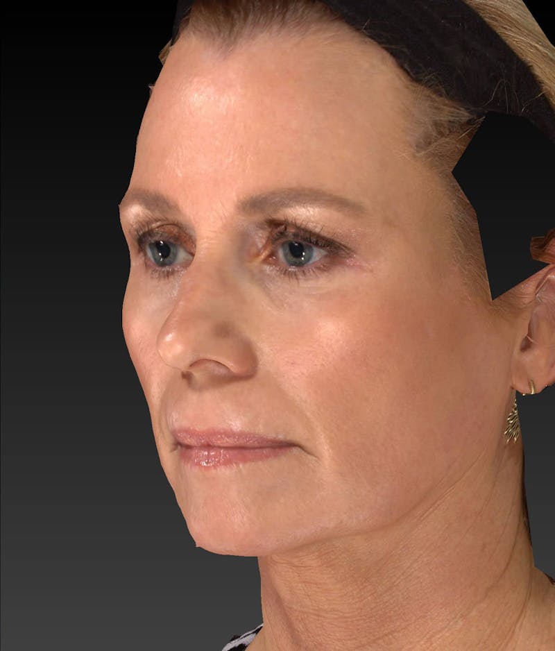 Temple Filling Before & After Gallery - Patient 205693 - Image 6
