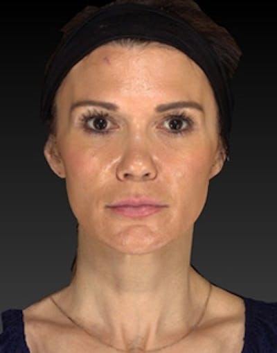 Temple Filling Before & After Gallery - Patient 388953 - Image 1