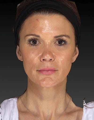 Temple Filling Before & After Gallery - Patient 388953 - Image 2