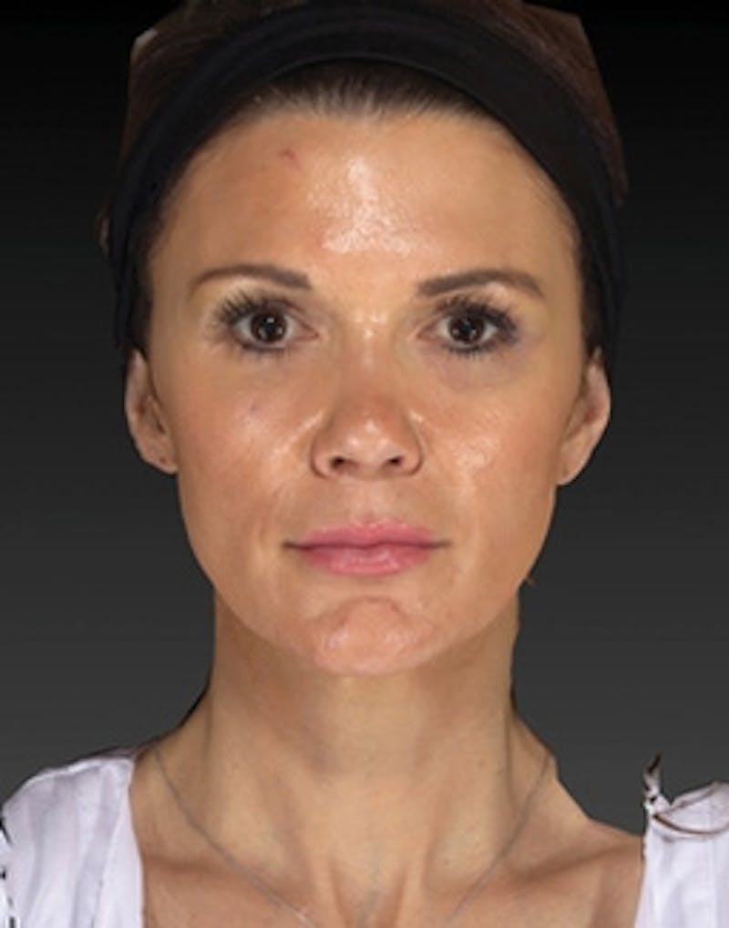 Temple Filling Before & After Gallery - Patient 388953 - Image 2