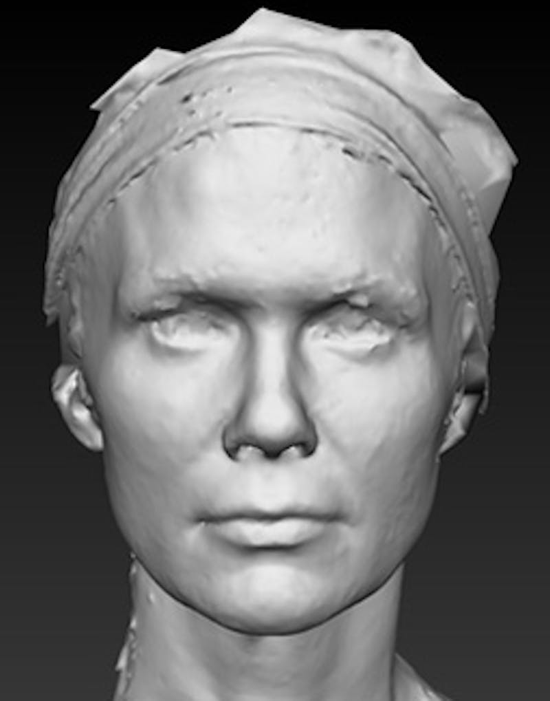 Temple Filling Before & After Gallery - Patient 388953 - Image 3