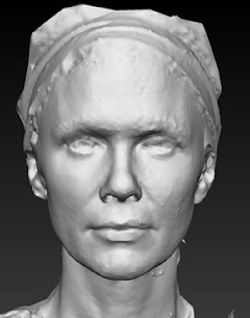 Temple Filling Before & After Gallery - Patient 388953 - Image 4