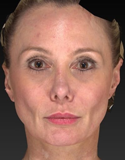 Temple Filling Before & After Gallery - Patient 179788 - Image 1