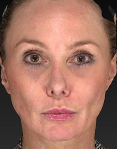 Temple Filling Before & After Gallery - Patient 179788 - Image 2