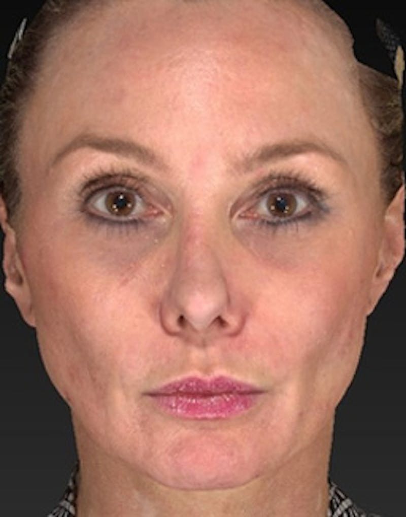 Temple Filling Before & After Gallery - Patient 179788 - Image 2