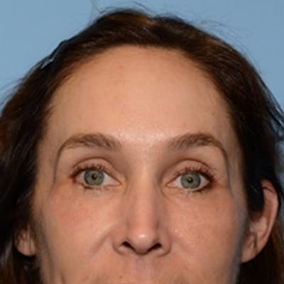 Temple Filling Before & After Gallery - Patient 395155 - Image 1