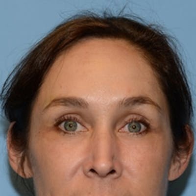 Temple Filling Before & After Gallery - Patient 395155 - Image 2