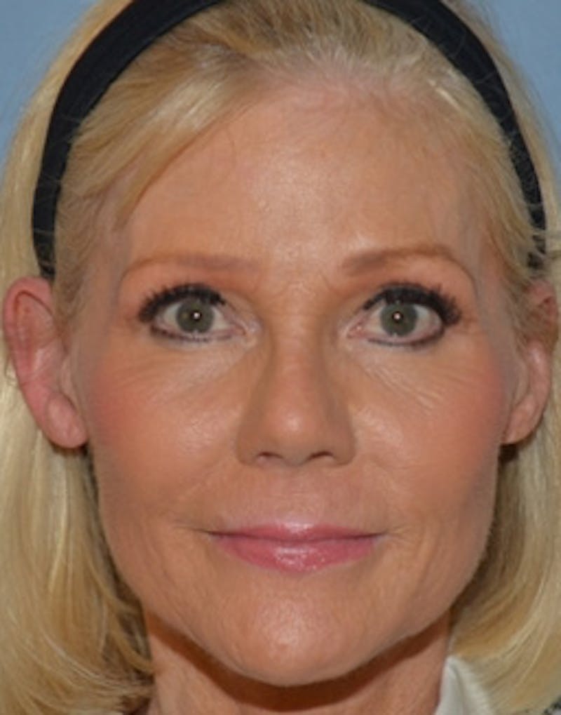 Temple Filling Before & After Gallery - Patient 393277 - Image 1