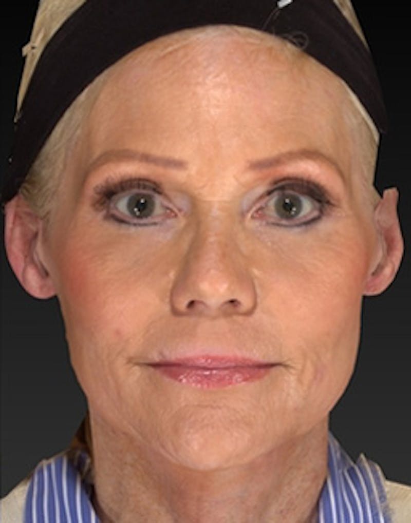 Temple Filling Before & After Gallery - Patient 393277 - Image 3