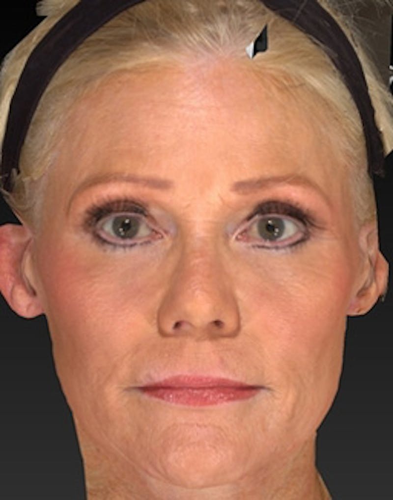 Temple Filling Before & After Gallery - Patient 393277 - Image 4