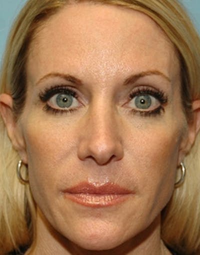 Temple Filling Before & After Gallery - Patient 215622 - Image 1