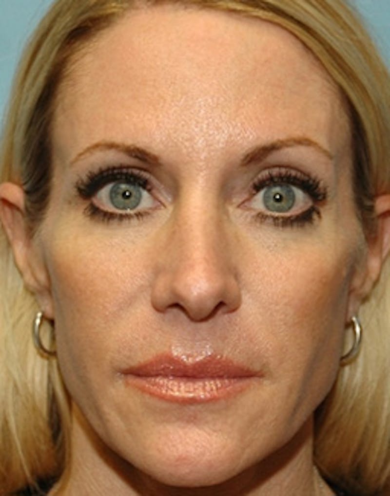 Temple Filling Before & After Gallery - Patient 215622 - Image 1
