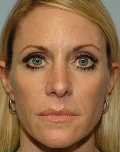 Temple Filling Before & After Gallery - Patient 215622 - Image 2