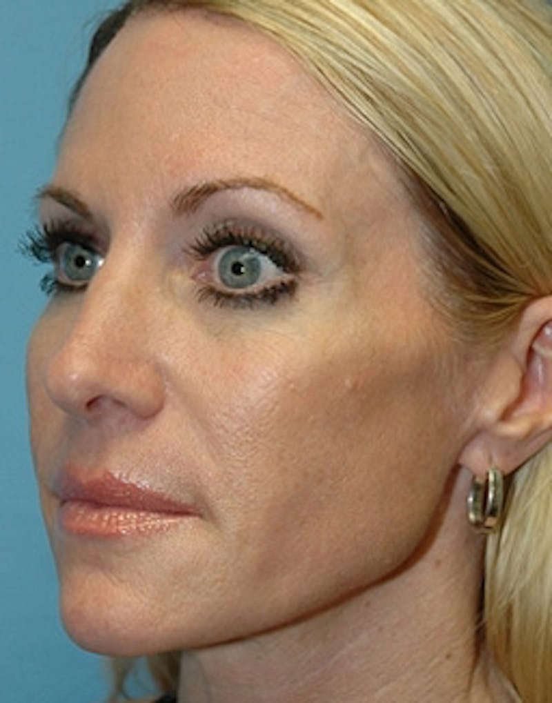 Temple Filling Before & After Gallery - Patient 215622 - Image 3