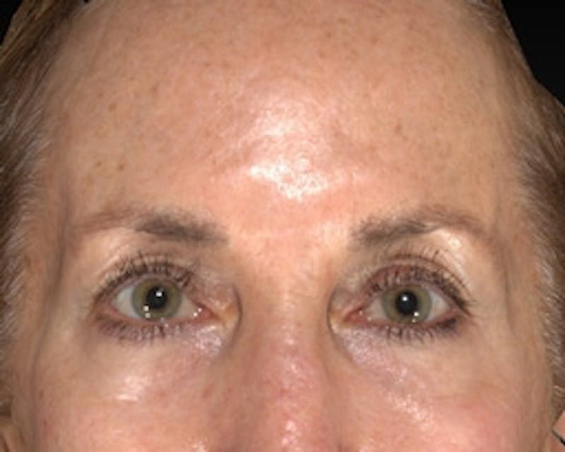 Temple Filling Before & After Gallery - Patient 377581 - Image 1