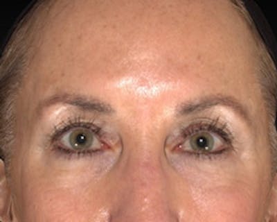 Temple Filling Before & After Gallery - Patient 377581 - Image 2