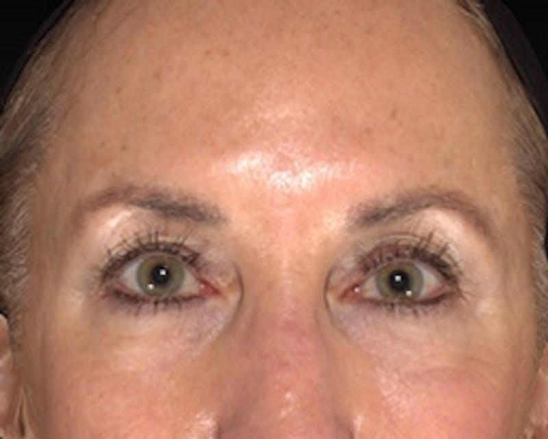 Temple Filling Before & After Gallery - Patient 377581 - Image 2