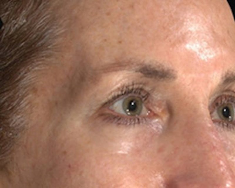 Temple Filling Before & After Gallery - Patient 377581 - Image 3