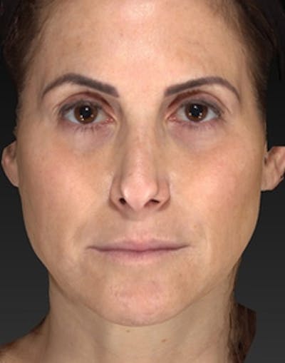 Temple Filling Before & After Gallery - Patient 341614 - Image 1
