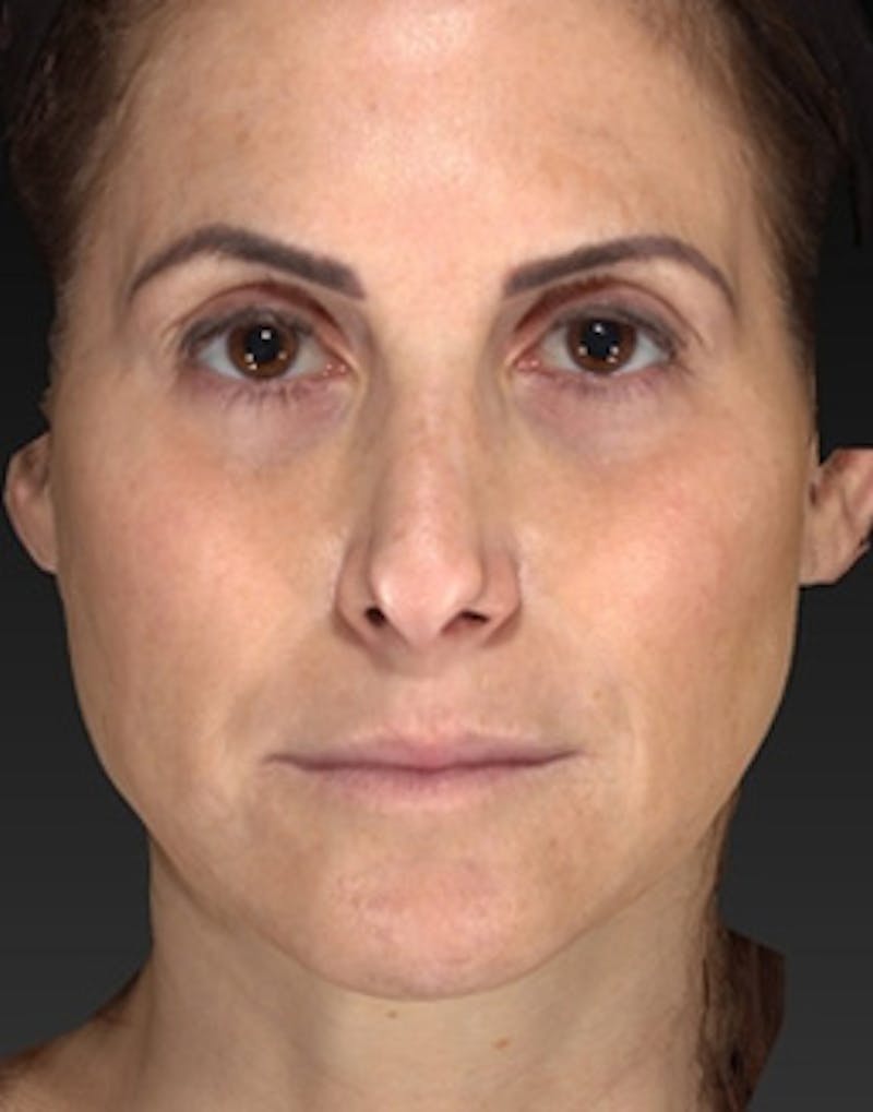 Temple Filling Before & After Gallery - Patient 341614 - Image 1