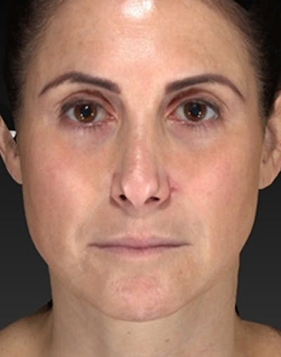 Temple Filling Before & After Gallery - Patient 341614 - Image 2