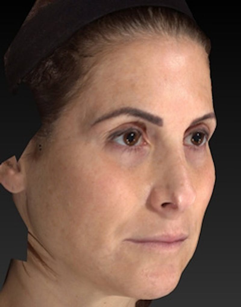 Temple Filling Before & After Gallery - Patient 341614 - Image 3
