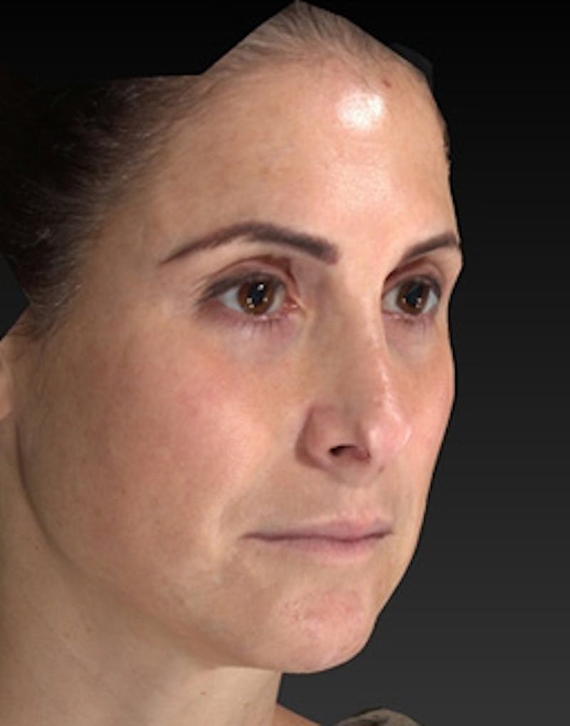 Temple Filling Before & After Gallery - Patient 341614 - Image 4