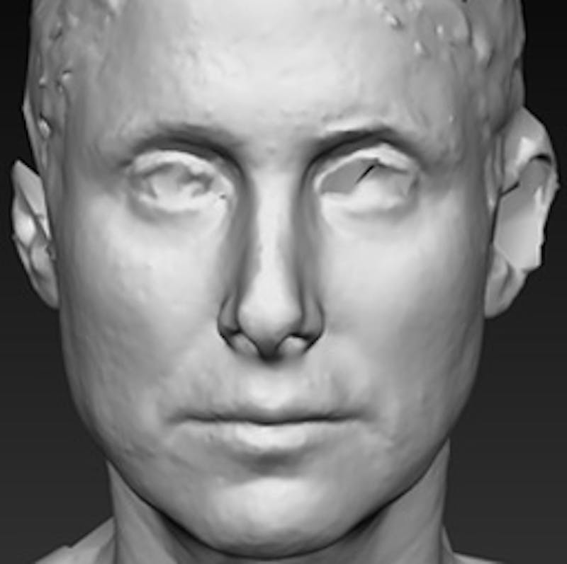 Temple Filling Before & After Gallery - Patient 341614 - Image 6