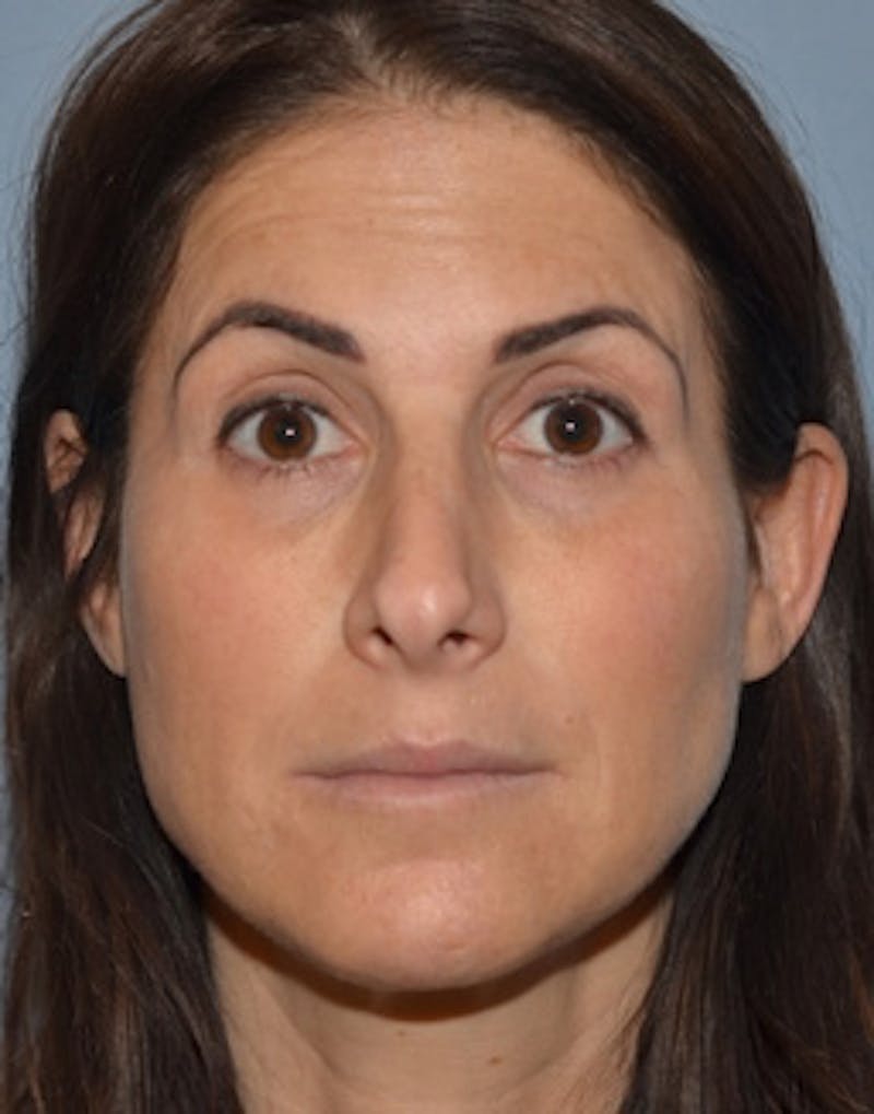 Temple Filling Before & After Gallery - Patient 341614 - Image 7