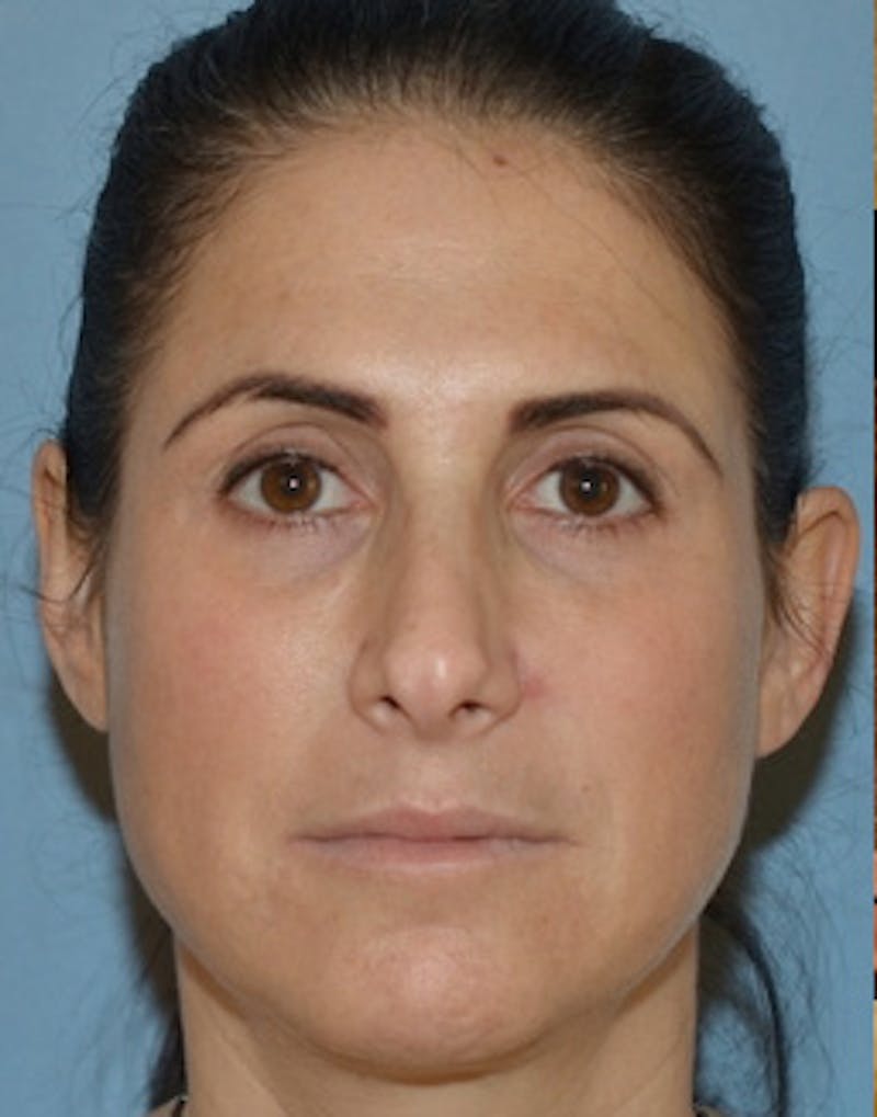 Temple Filling Before & After Gallery - Patient 341614 - Image 10