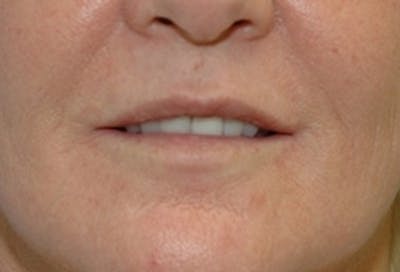 Lip Augmentation Before & After Gallery - Patient 398257 - Image 1