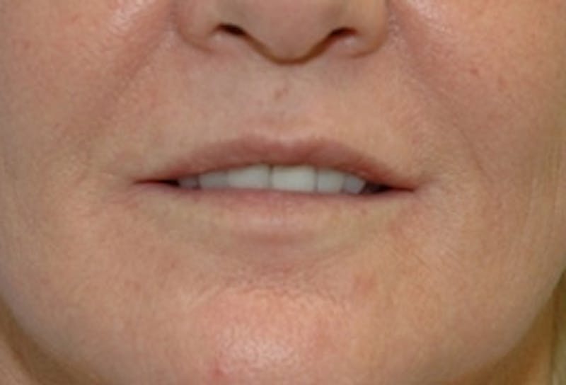 Lip Augmentation Before & After Gallery - Patient 398257 - Image 1
